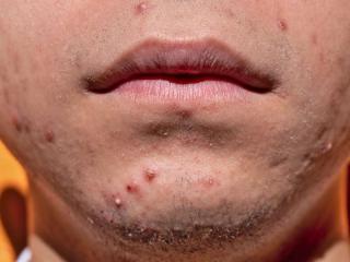 Symptoms and causes of acne