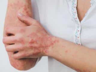Dermatitis plant treatments